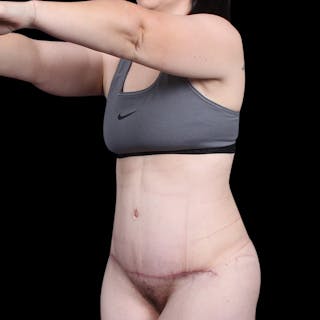 Tummy Tuck Before & After Gallery - Patient 139827 - Image 4