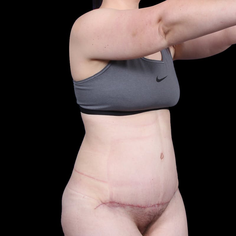 Tummy Tuck Before & After Gallery - Patient 139827 - Image 8