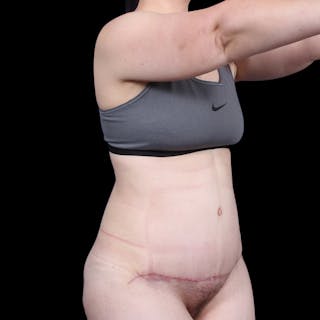 Tummy Tuck Before & After Gallery - Patient 139827 - Image 8