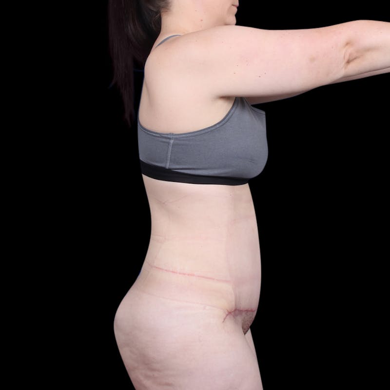 Tummy Tuck Before & After Gallery - Patient 139827 - Image 10