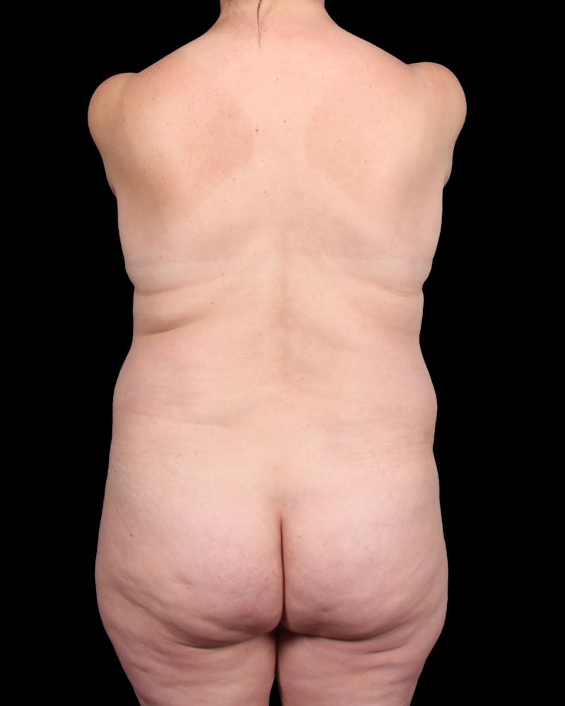 Tummy Tuck Before & After Gallery - Patient 147846 - Image 11