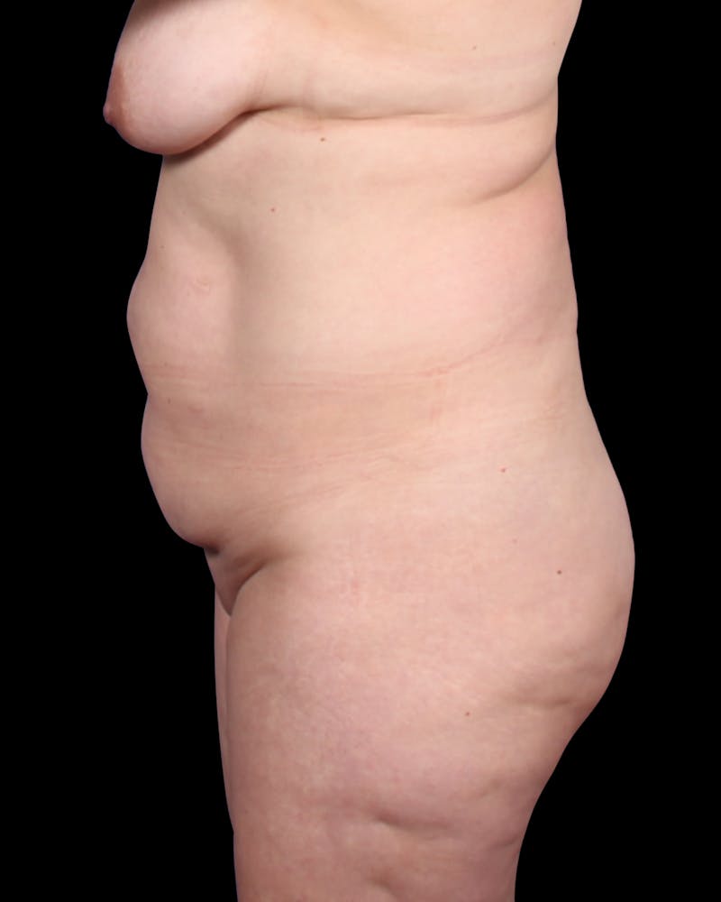 Tummy Tuck Before & After Gallery - Patient 147846 - Image 9