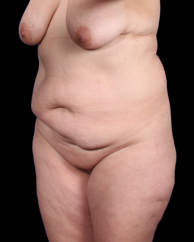 Tummy Tuck Before & After Gallery - Patient 147846 - Image 3