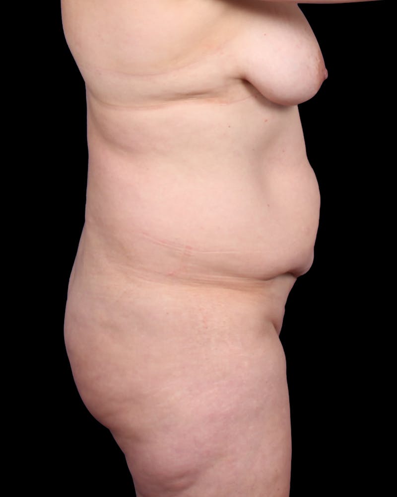 Tummy Tuck Before & After Gallery - Patient 147846 - Image 7