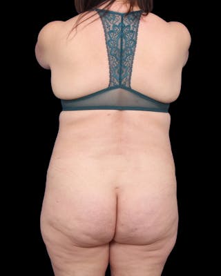 Tummy Tuck Before & After Gallery - Patient 147846 - Image 12