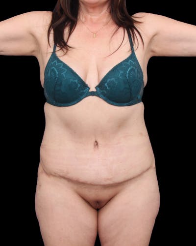 Tummy Tuck Before & After Gallery - Patient 147846 - Image 2