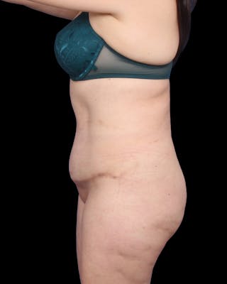 Tummy Tuck Before & After Gallery - Patient 147846 - Image 10