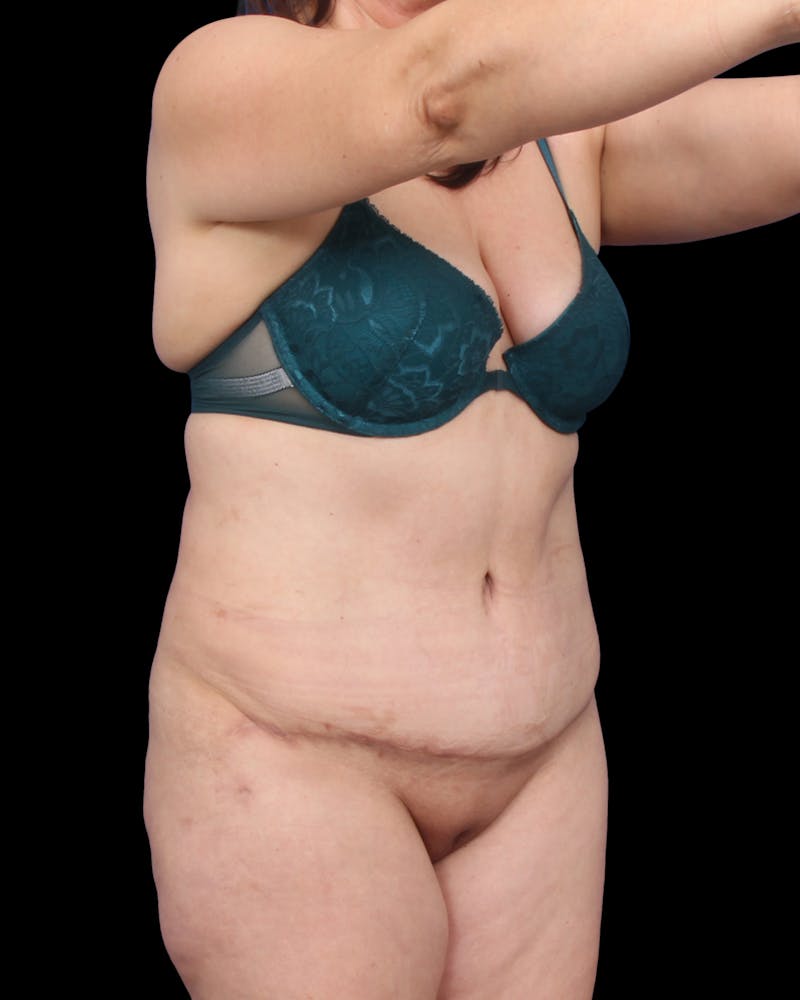 Tummy Tuck Before & After Gallery - Patient 147846 - Image 6