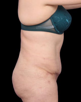 Tummy Tuck Before & After Gallery - Patient 147846 - Image 8