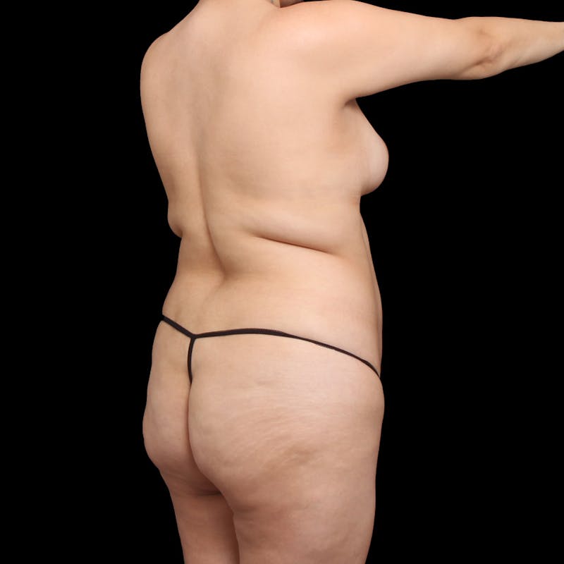Liposuction Before & After Gallery - Patient 225293 - Image 7