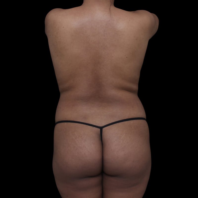 Brazilian Butt Lift Before & After Gallery - Patient 181623 - Image 3