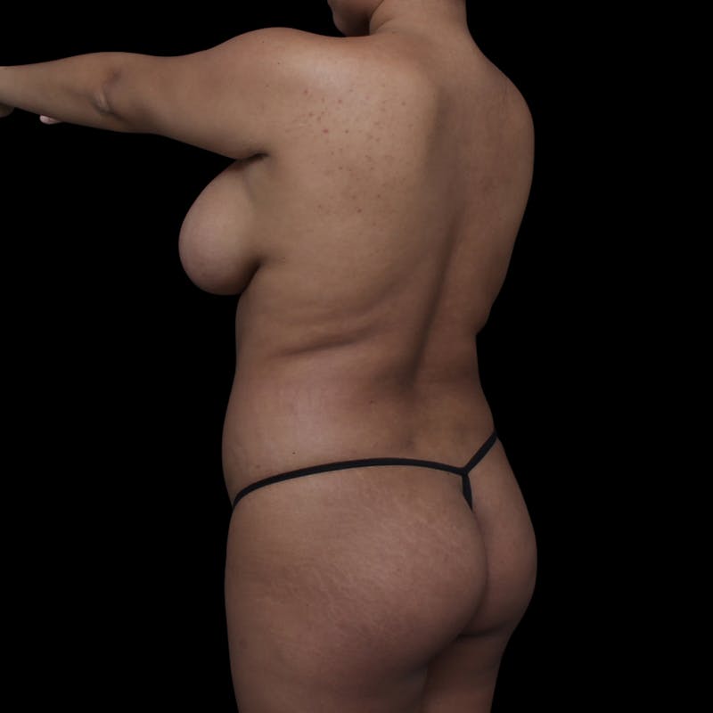 Brazilian Butt Lift Before & After Gallery - Patient 181623 - Image 5