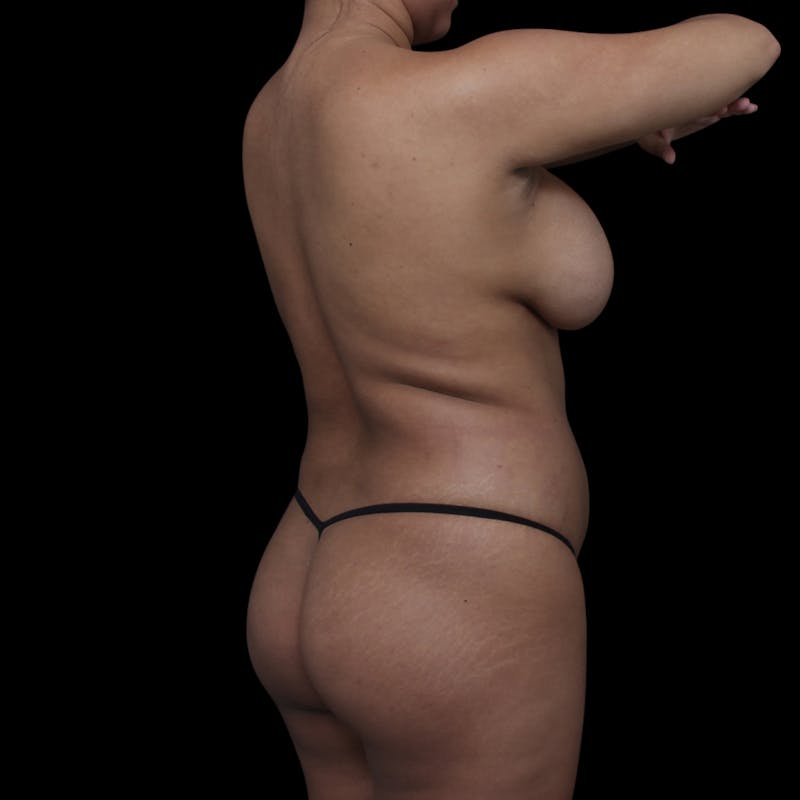 Brazilian Butt Lift Before & After Gallery - Patient 181623 - Image 1