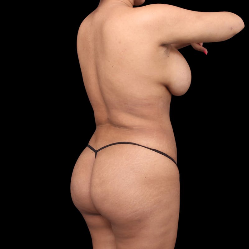 Brazilian Butt Lift Before & After Gallery - Patient 181623 - Image 2