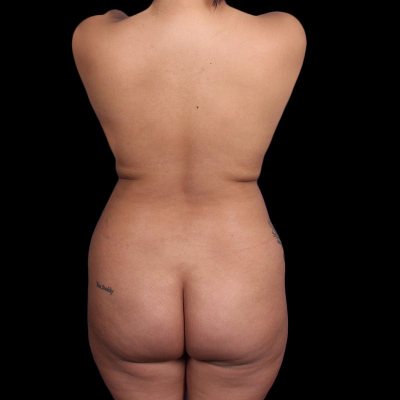 Brazilian Butt Lift Before & After Gallery - Patient 706278 - Image 1