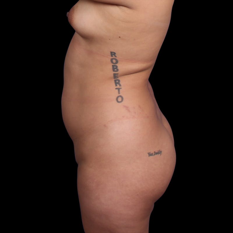 Brazilian Butt Lift Before & After Gallery - Patient 706278 - Image 5