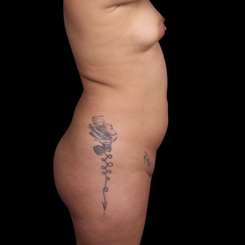 Brazilian Butt Lift Before & After Gallery - Patient 706278 - Image 7