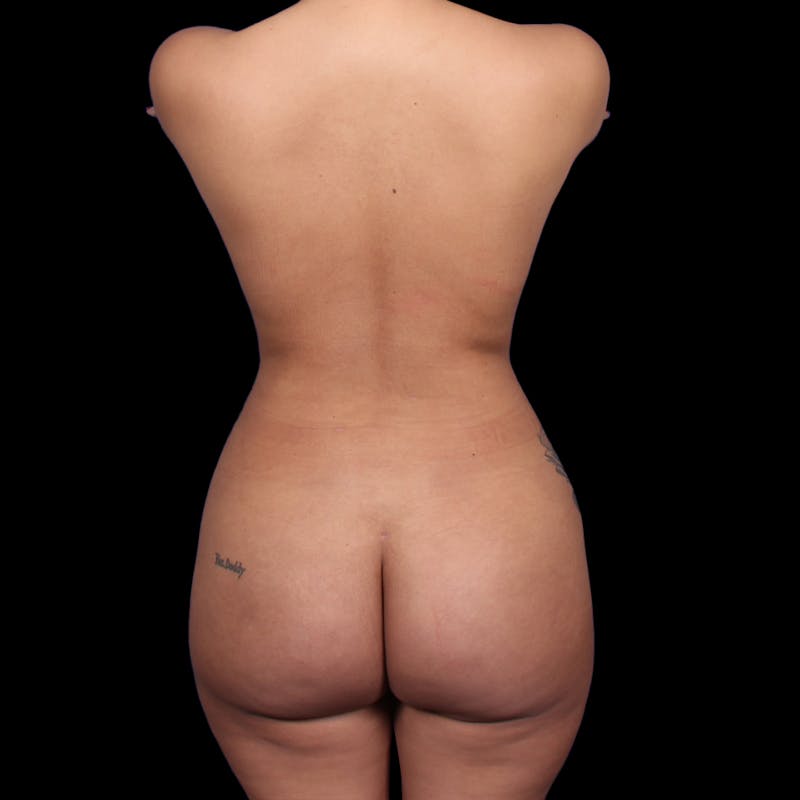 Brazilian Butt Lift Before & After Gallery - Patient 706278 - Image 2
