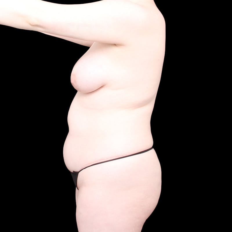 Brazilian Butt Lift Before & After Gallery - Patient 421423 - Image 7