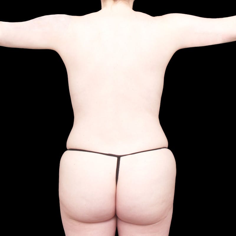 Brazilian Butt Lift Before & After Gallery - Patient 421423 - Image 4