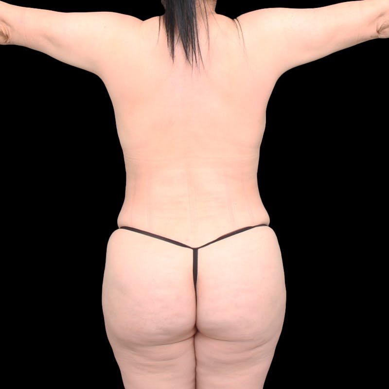 Brazilian Butt Lift Before & After Gallery - Patient 701417 - Image 4