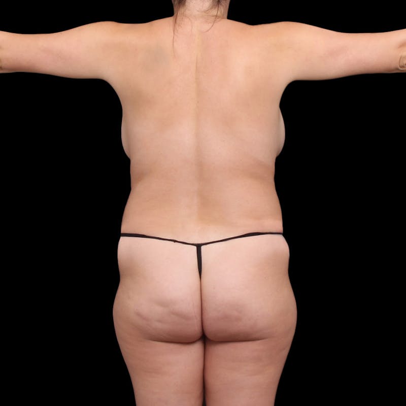 Brazilian Butt Lift Before & After Gallery - Patient 994239 - Image 3