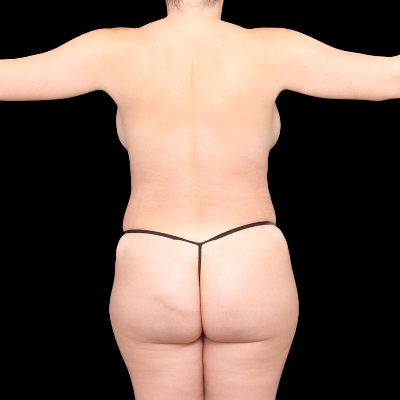 Liposuction Before & After Gallery - Patient 236795 - Image 16
