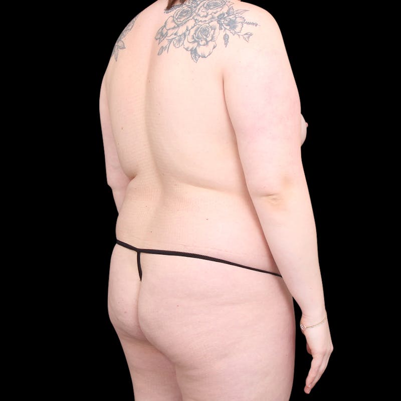 Brazilian Butt Lift Before & After Gallery - Patient 392532 - Image 1