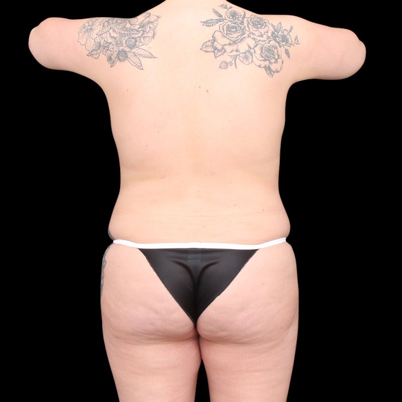 Brazilian Butt Lift Before & After Gallery - Patient 392532 - Image 4