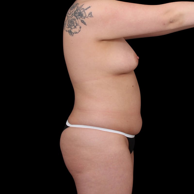 Brazilian Butt Lift Before & After Gallery - Patient 392532 - Image 8