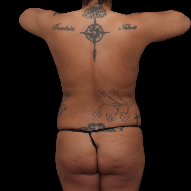 Brazilian Butt Lift Before & After Gallery - Patient 232407 - Image 3