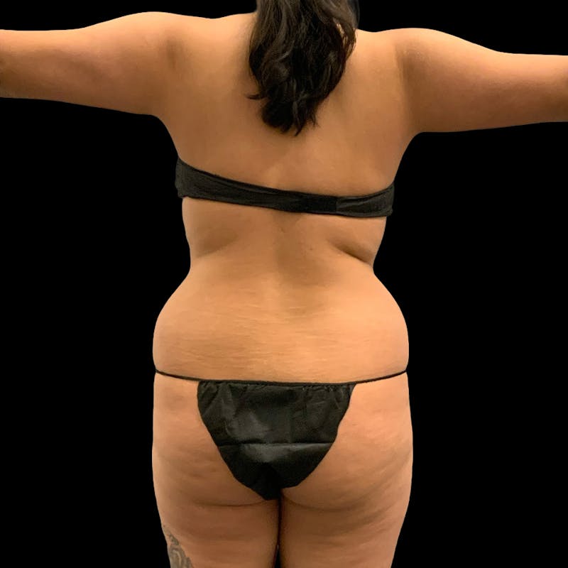 Brazilian Butt Lift Before & After Gallery - Patient 271466 - Image 3