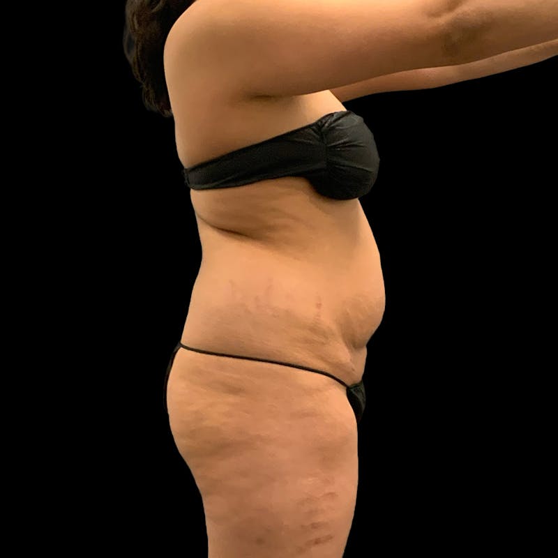 Brazilian Butt Lift Before & After Gallery - Patient 271466 - Image 7
