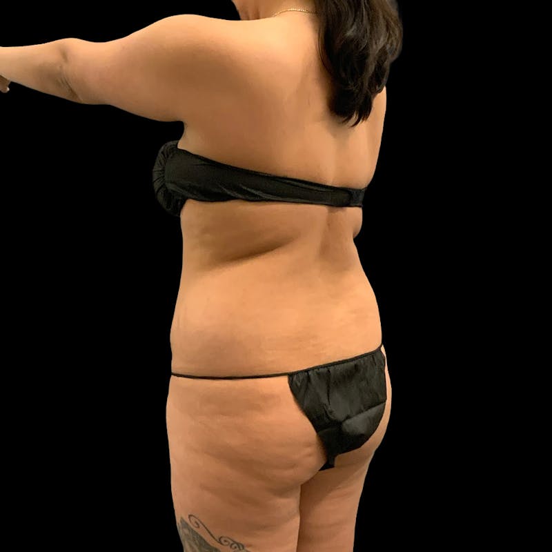 Brazilian Butt Lift Before & After Gallery - Patient 271466 - Image 5