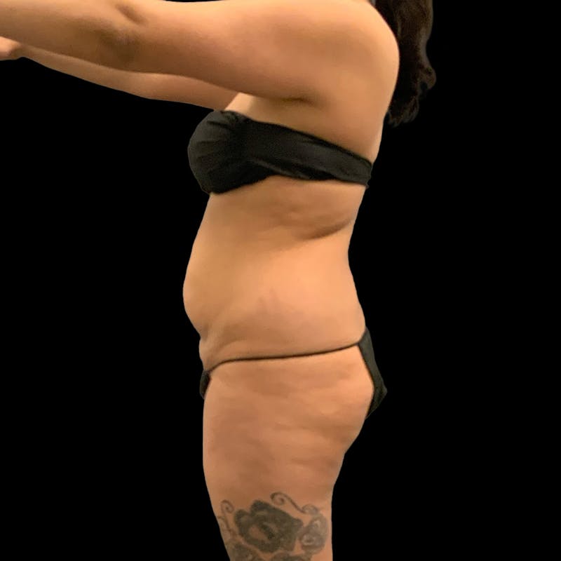 Brazilian Butt Lift Before & After Gallery - Patient 271466 - Image 9