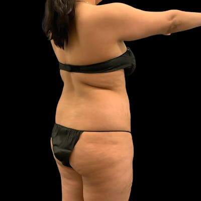 Brazilian Butt Lift Before & After Gallery - Patient 271466 - Image 1