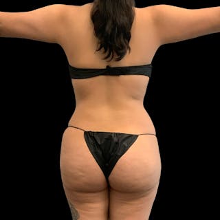 Brazilian Butt Lift Before & After Gallery - Patient 271466 - Image 4
