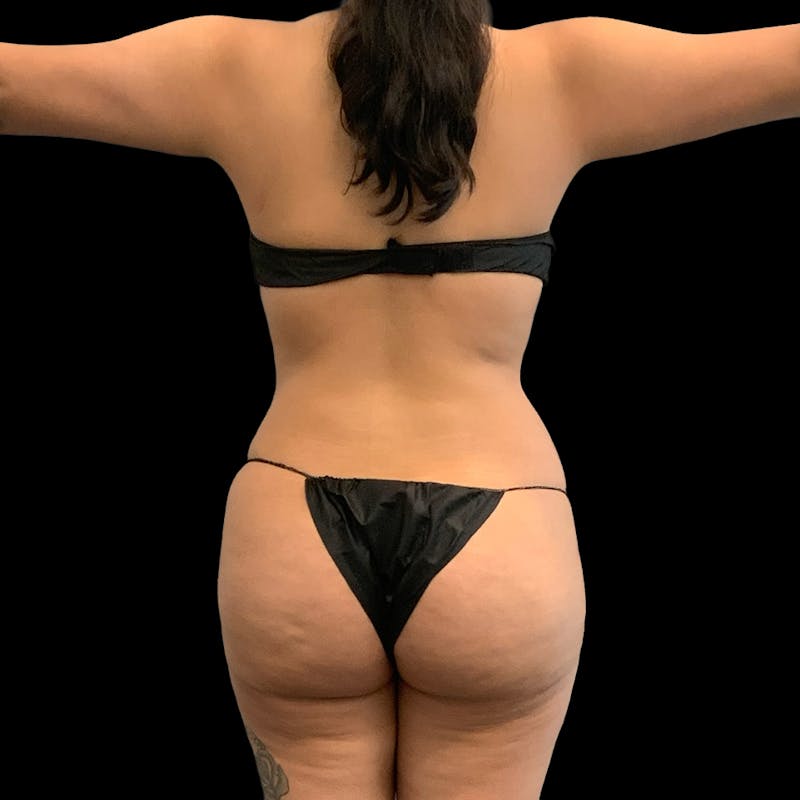 Brazilian Butt Lift Before & After Gallery - Patient 271466 - Image 4