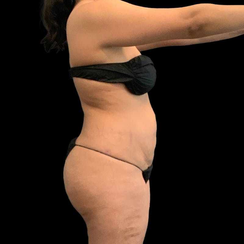 Brazilian Butt Lift Before & After Gallery - Patient 271466 - Image 8
