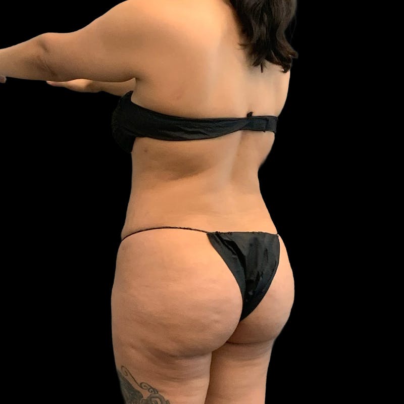 Brazilian Butt Lift Before & After Gallery - Patient 271466 - Image 6