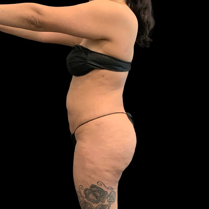 Brazilian Butt Lift Before & After Gallery - Patient 271466 - Image 10