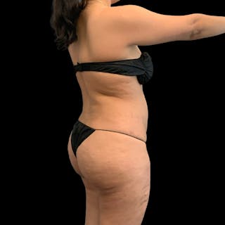 Brazilian Butt Lift Before & After Gallery - Patient 271466 - Image 2