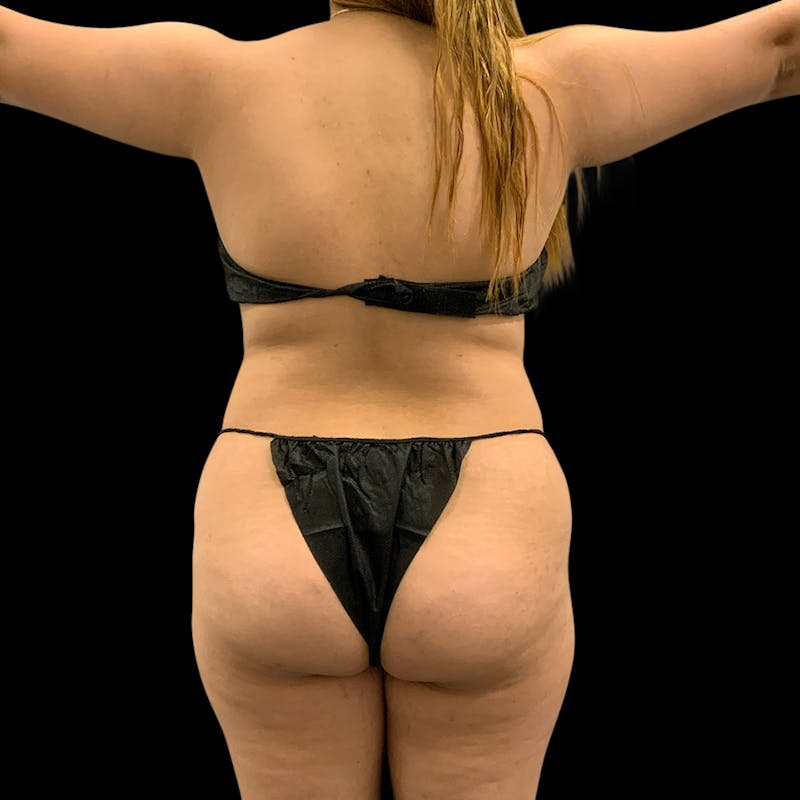 Brazilian Butt Lift Before & After Gallery - Patient 360690 - Image 3