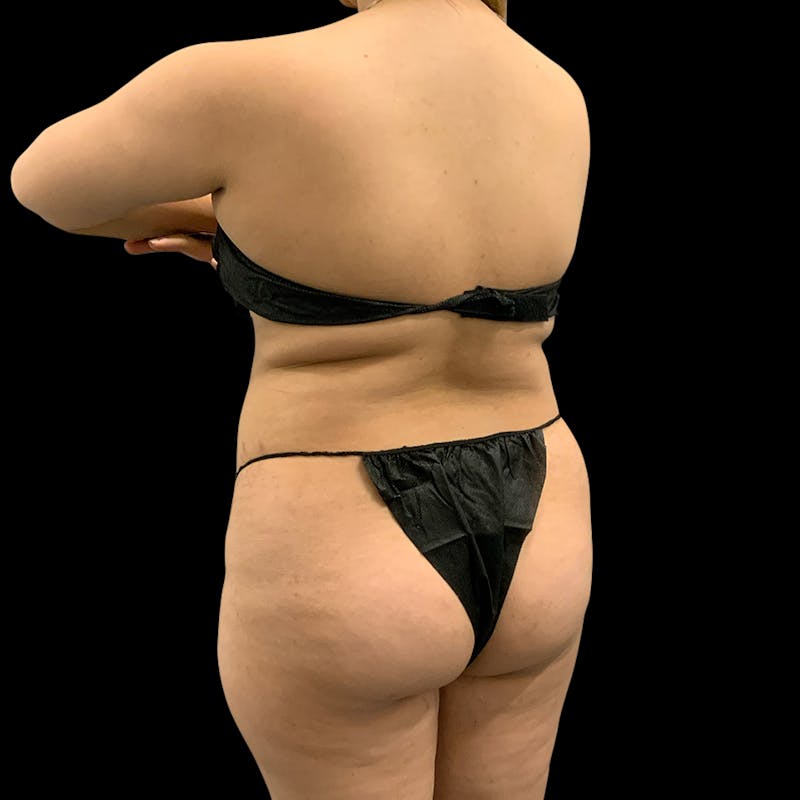 Brazilian Butt Lift Before & After Gallery - Patient 360690 - Image 7
