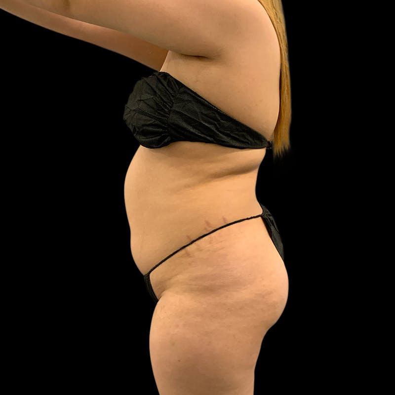 Brazilian Butt Lift Before & After Gallery - Patient 360690 - Image 5