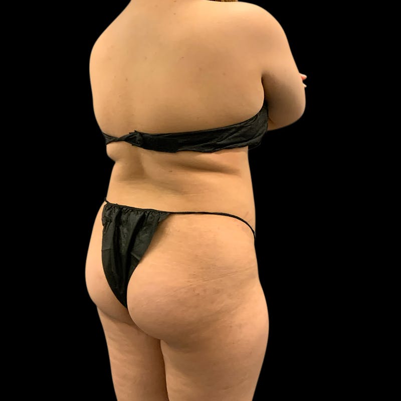 Brazilian Butt Lift Before & After Gallery - Patient 360690 - Image 1