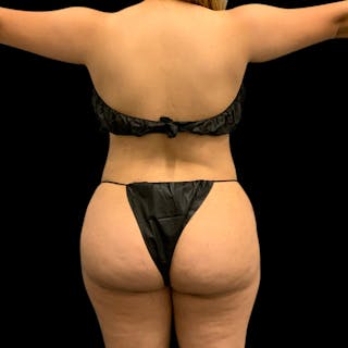 Brazilian Butt Lift Before & After Gallery - Patient 360690 - Image 4