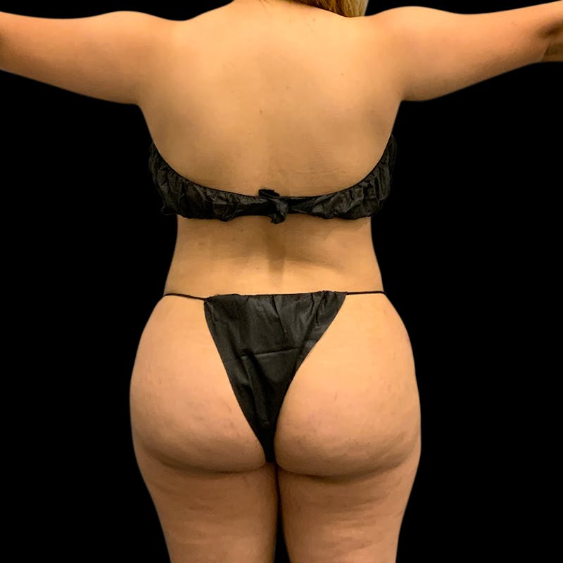 Brazilian Butt Lift Before & After Gallery - Patient 360690 - Image 4