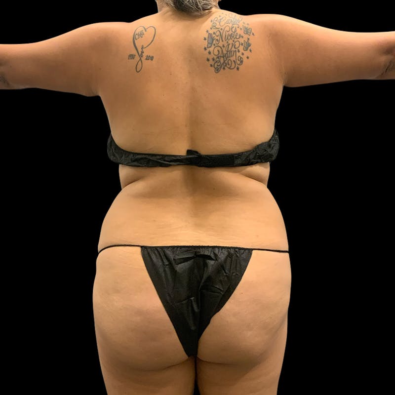 Brazilian Butt Lift Before & After Gallery - Patient 211801 - Image 3