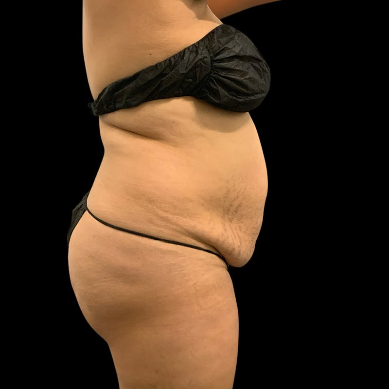 Brazilian Butt Lift Before & After Gallery - Patient 211801 - Image 9
